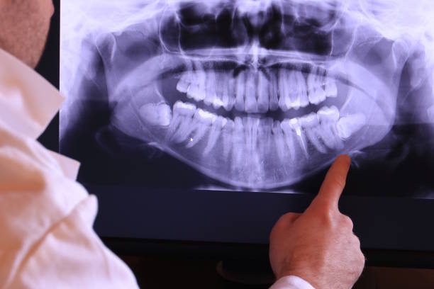 Best Knocked-Out Tooth (Avulsed Tooth) Treatment in Chesapeake, VA